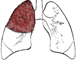 Lung Affected By Lobar Pneumonia